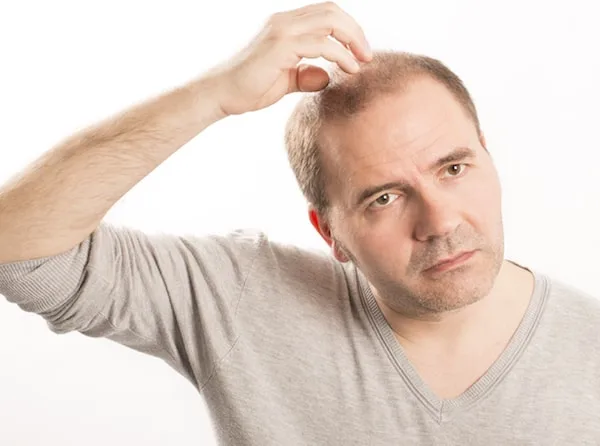 male hair loss